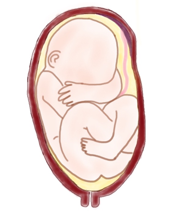 breech-births-birth-through-history